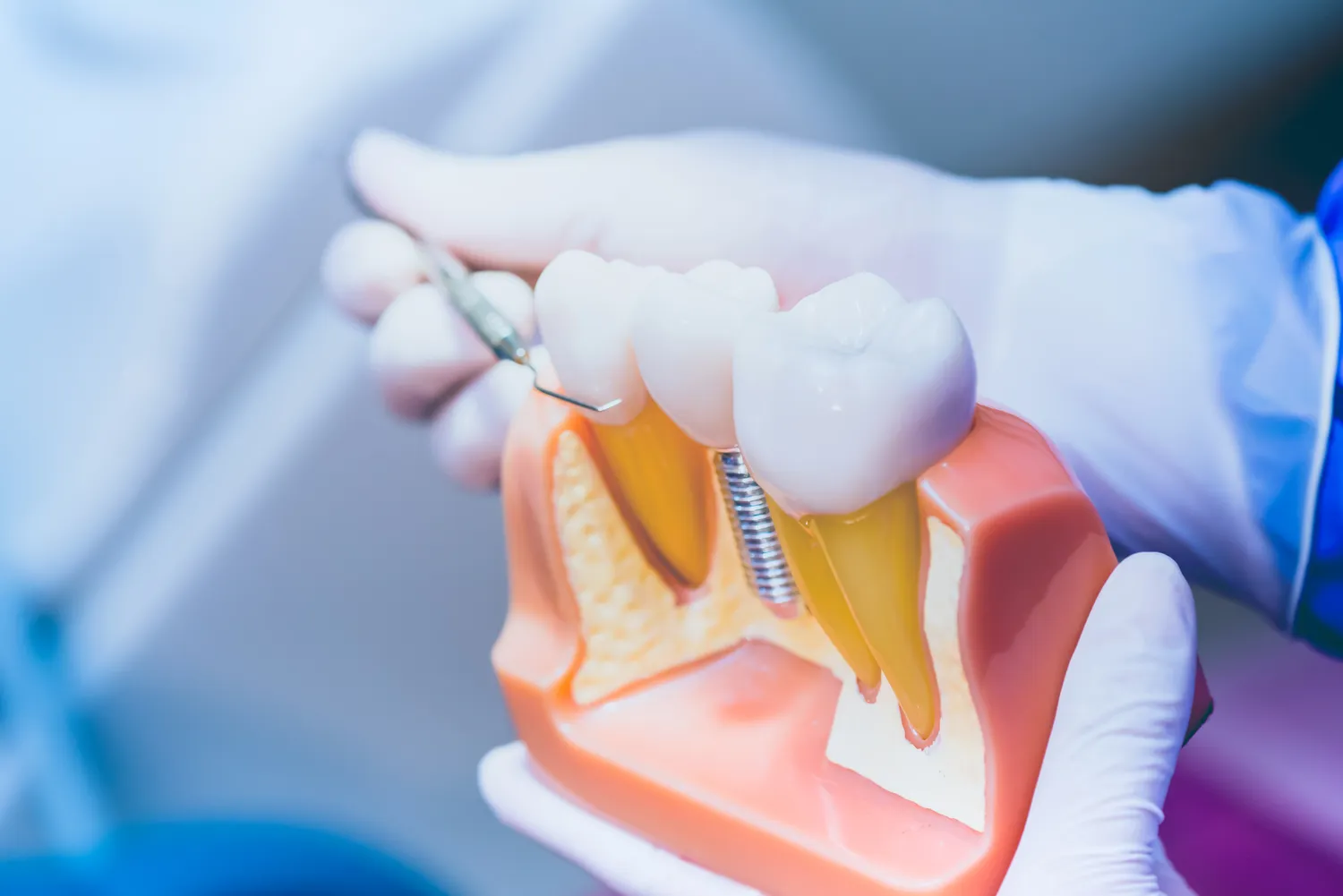 Kiedy po wyrwaniu zęba można wstawić implant? Kiedy po wyrwaniu zęba można wstawić implant?