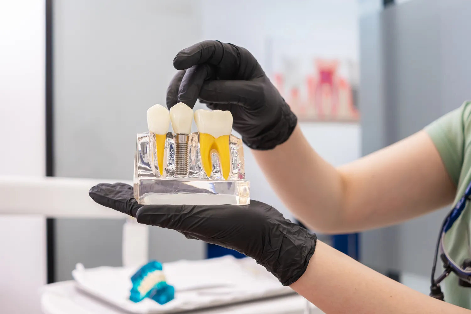 Co to są implanty zębowe?